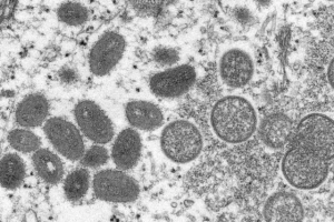 viruela-del-mono-1-62879c7671ee9-640x426